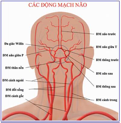 Hẹp động mạch cảnh, nguy hiểm thế nào?